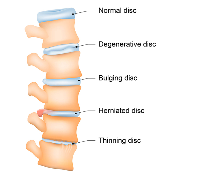 Sound Pain Solutions Treatment Spine Disc Diagram